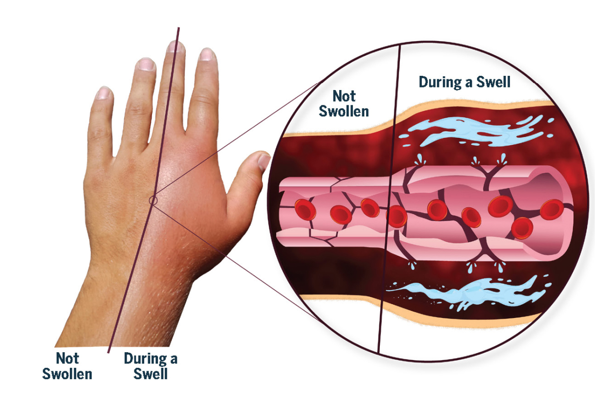 Picture of a hand experiencing a swell. It shows a normal hand and version where the hand and fingers are swollen.